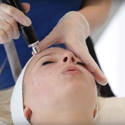 Microdermabrasion At Hemaxi Beauty Birmingham